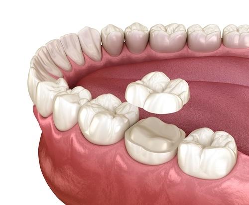 inlay going onto a tooth