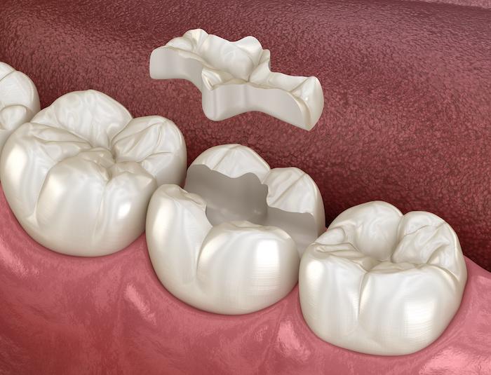 inlay going onto a tooth