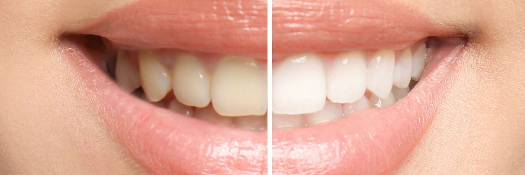A before and after results of teeth whitening in Wellesley, MA